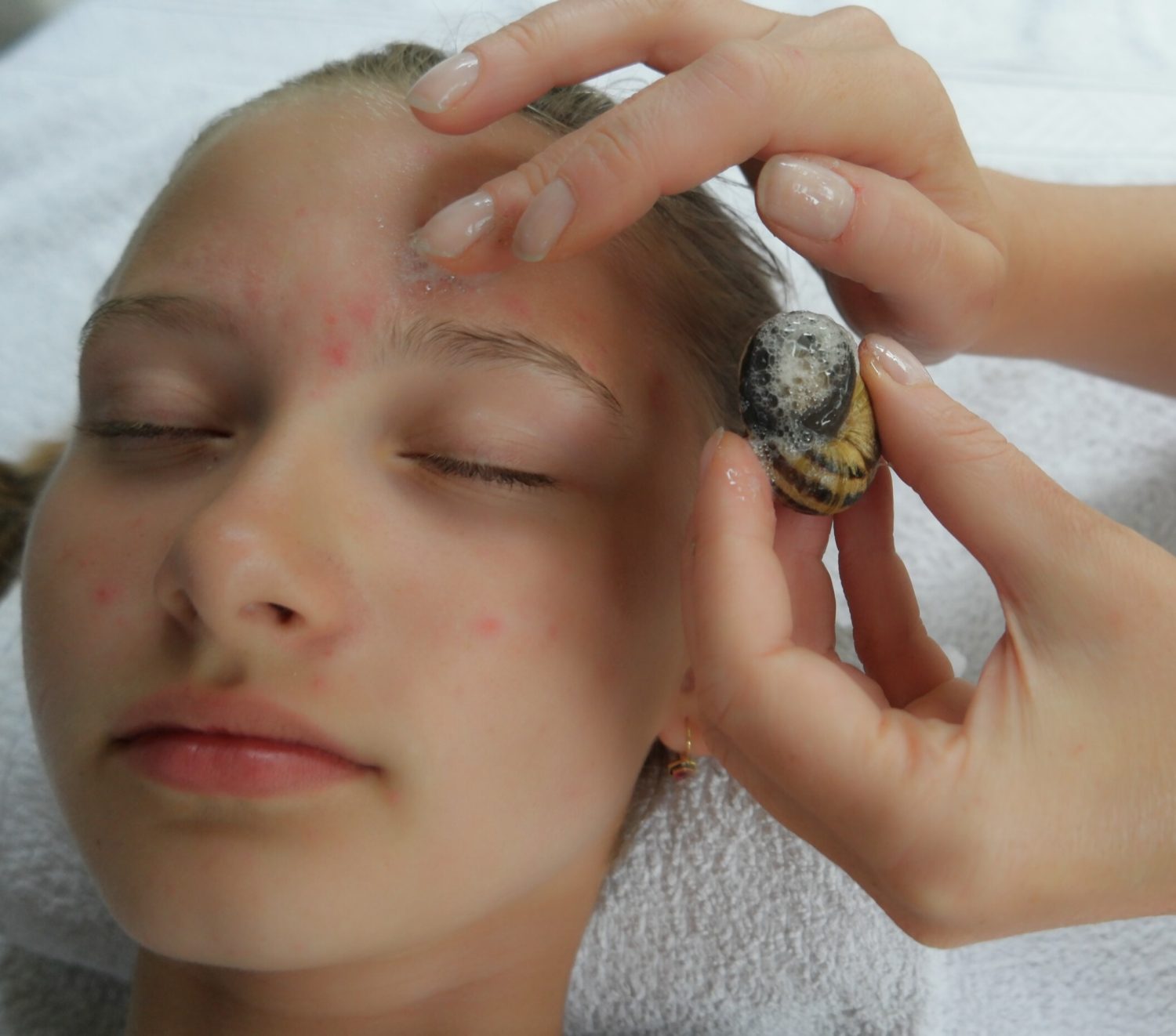 Schnecken-Behandlungen bei Jugend-Akne, Anwendungen zur Hautverjüngung für das Hautgewebe